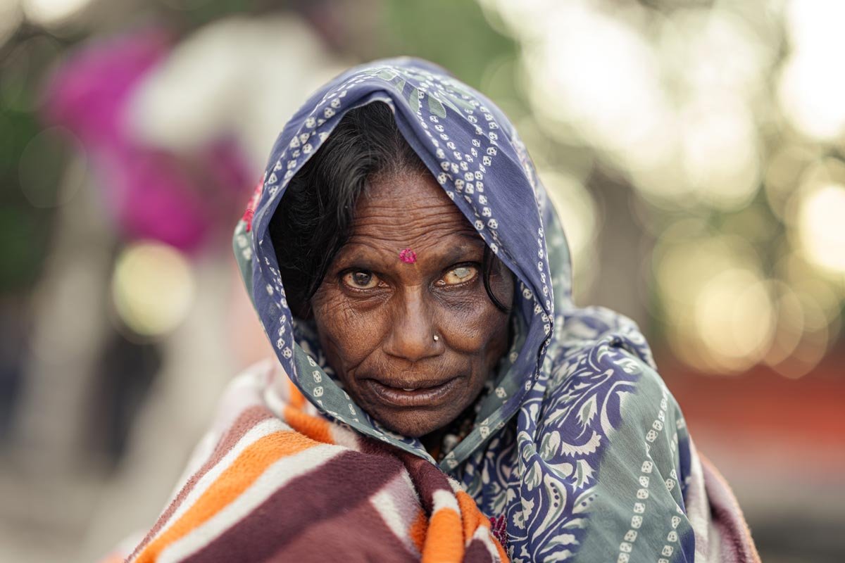 a woman with one damaged eye